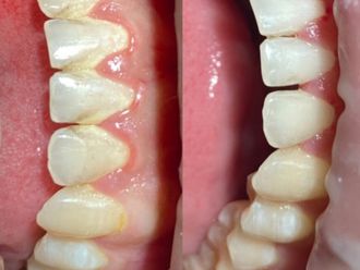 Limpieza dental antes y después - 875412