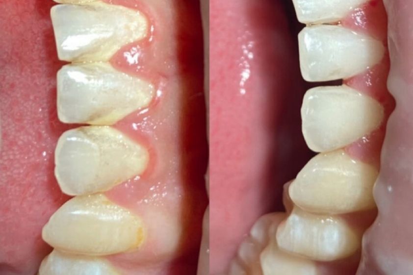 Limpieza dental antes y después - 875412