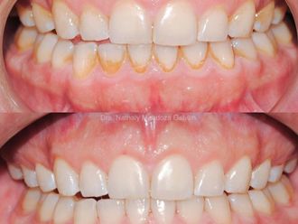 Limpieza dental antes y después - 875482