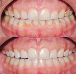 Limpieza Dental - Odontóloga Macarena Robledo