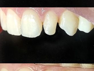 Carillas dentales antes y después - 875483