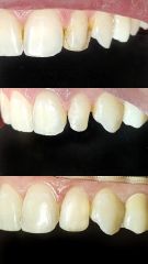 Carillas Dentales -Odontóloga Macarena Robledo