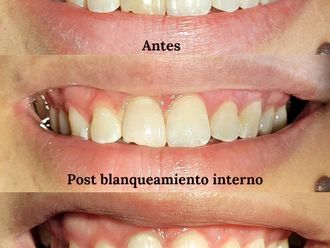 Blanqueamiento dental antes y después - 875487