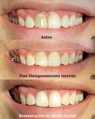 Blanqueamiento dental - Odontóloga Macarena Robledo