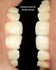 Carillas Dentales - Odontóloga Macarena Robledo