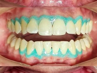 Blanqueamiento dental antes y después - 875489