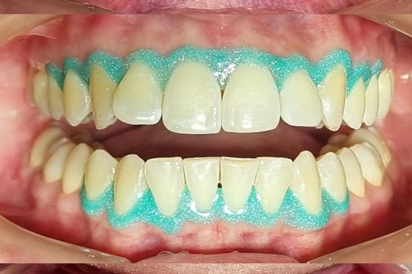 Blanqueamiento dental antes y después - 875489