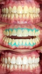 Blanqueamiento Dental - Odontóloga Macarena Robledo