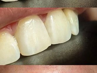 Carillas dentales antes y después - 875586