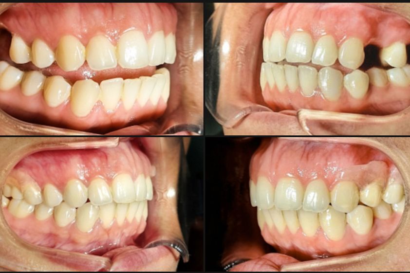 Prótesis dentales antes y después - 875590