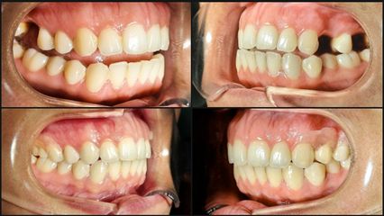 Prótesis Dentales - Odontóloga Macarena Robledo