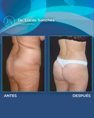 Liposucción - Dr. Lucas Sánchez