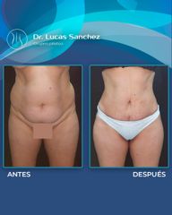 Liposucción - Dr. Lucas Sánchez