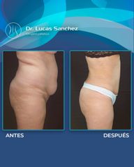 Liposucción - Dr. Lucas Sánchez