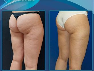 Liposucción antes y después - 870976