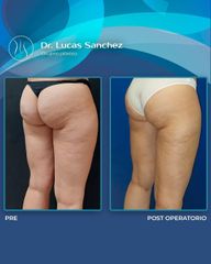 Liposucción - Dr. Lucas Sánchez