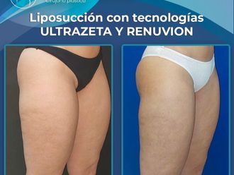 Liposucción antes y después - 870977