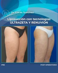 Liposucción - Dr. Lucas Sánchez