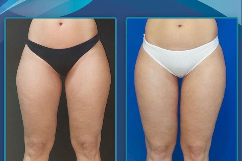 Liposucción antes y después - 870978