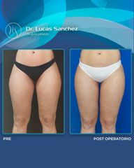 Liposucción - Dr. Lucas Sánchez