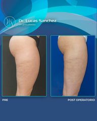 Liposucción - Dr. Lucas Sánchez