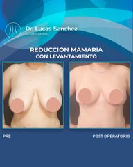 Reducción de mamas - Dr. Lucas Sánchez