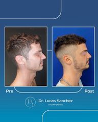 Mentoplastia - Dr. Lucas Sánchez