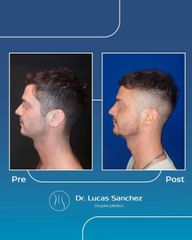 Mentoplastia - Dr. Lucas Sánchez