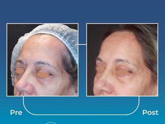 Blefaroplastia antes y después - 871006