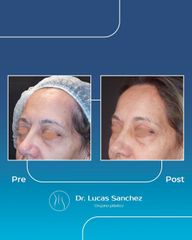 Blefaroplastia - Dr. Lucas Sánchez