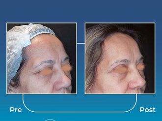 Blefaroplastia antes y después - 871007