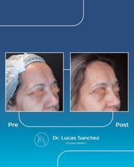 Blefaroplastia - Dr. Lucas Sánchez