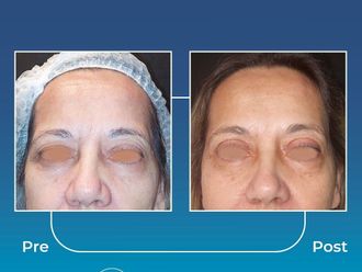 Blefaroplastia antes y después - 871008