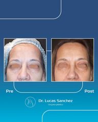 Blefaroplastia - Dr. Lucas Sánchez