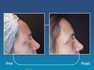 Blefaroplastia antes y después - 871009