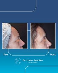 Blefaroplastia - Dr. Lucas Sánchez