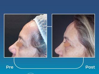 Blefaroplastia antes y después - 871010