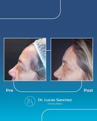 Blefaroplastia - Dr. Lucas Sánchez