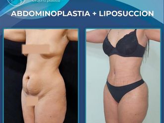 Abdominoplastía antes y después - 879763