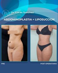 ANTES Y DESPUÉS