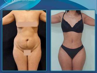 Abdominoplastía antes y después - 879764