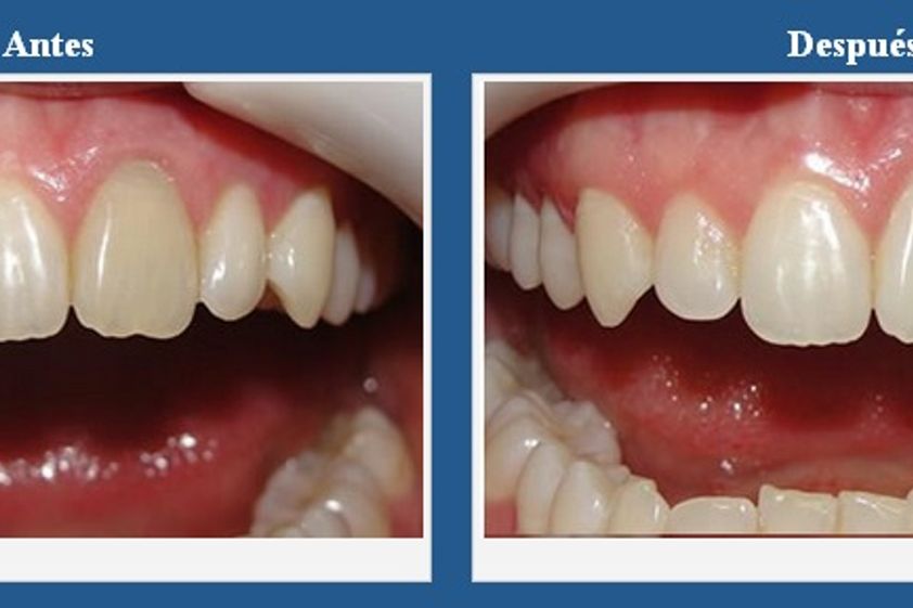 Blanqueamiento dental antes y después - 267714