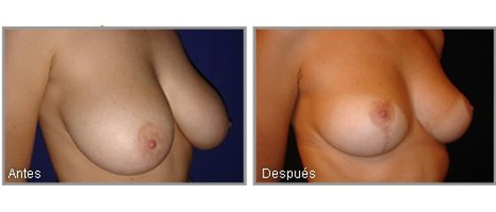 Mamoplastía Reductora