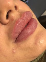 Relleno-volumen de labios con ácido hialuronico