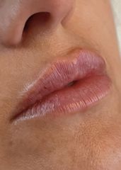 Relleno - Volumen de labios con ácido hialuronico