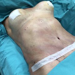 Cirugía combinada de Abdominoplastia con Aumento mamario