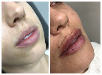 Relleno de labios - Dra. Natalia De Magistra