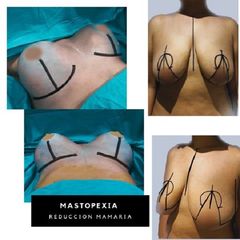 Reducción de mamas - Dra. Natalia De Magistra