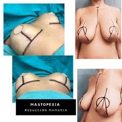 Reducción de mamas - Dra. Natalia De Magistra