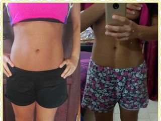 Endopeel/retensado cutaneo de abdomen